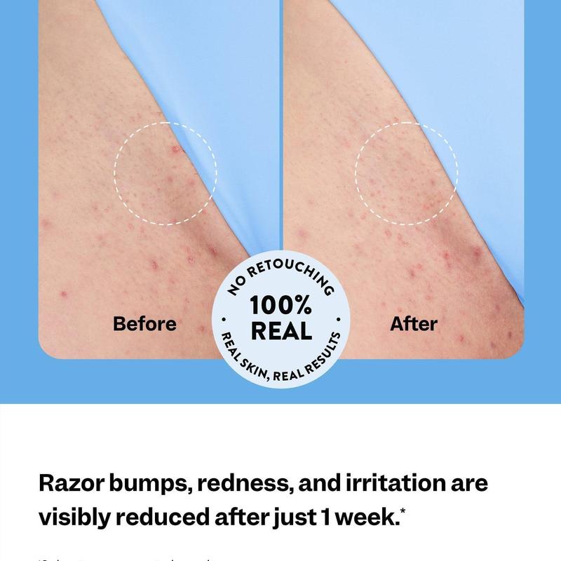Ingrown Hair Treatment